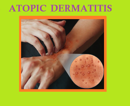 ATOPIC DERMATITIS