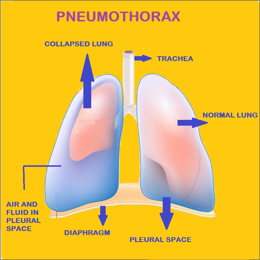 PNEUMOTHORAX Health And Lifestyle